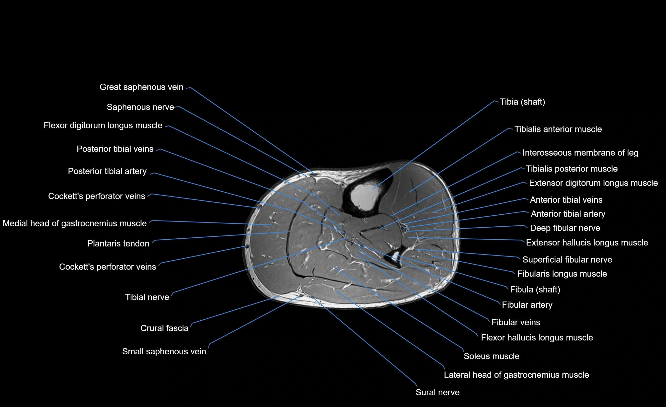 MRI lower leg axial cross sectional anatomy 3T  radiology  image-img-00001-00042.webp